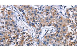 Immunohistochemistry of paraffin-embedded Human lung cancer tissue using MPO Polyclonal Antibody at dilution 1:50 (Myeloperoxidase anticorps)