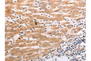 The image on the left is immunohistochemistry of paraffin-embedded Human liver cancer tissue using ABIN7190920(HCRTR1 Antibody) at dilution 1/70, on the right is treated with synthetic peptide. (HCRTR1 anticorps)