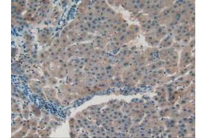 IHC-P analysis of Human Liver Cancer Tissue, with DAB staining. (APOC1 anticorps  (AA 31-83))