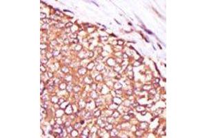 Formalin-fixed and paraffin-embedded human cancer tissue reacted with the primary antibody, which was peroxidase-conjugated to the secondary antibody, followed by DAB staining. (PKC theta anticorps  (C-Term))