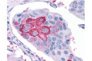 Anti-RORC / ROR Gamma antibody IHC of human Breast, Carcinoma.
