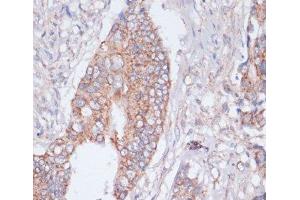Immunohistochemistry of paraffin-embedded Human colon cancer using MBTPS1 Polyclonal Antibody at dilution of 1:100 (40x lens). (MBTPS1 anticorps)