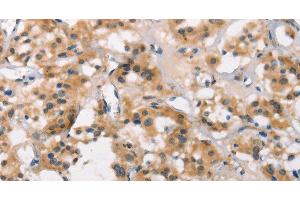 Immunohistochemistry of paraffin-embedded Human thyroid cancer using MARC1 Polyclonal Antibody at dilution of 1:40 (MOSC1 anticorps)