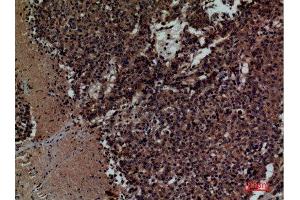 Immunohistochemistry (IHC) analysis of paraffin-embedded Human Lung Cancer, antibody was diluted at 1:100.