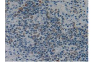 IHC-P analysis of Human Skin Cancer Tissue, with DAB staining.