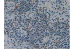 IHC-P analysis of Human Skin Cancer Tissue, with DAB staining. (Fibrillin 1 anticorps  (AA 723-902))