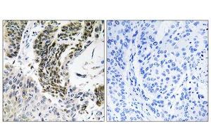 Immunohistochemistry analysis of paraffin-embedded human lung carcinoma tissue using RREB1 antibody. (RREB1 anticorps  (Internal Region))