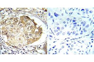 Immunohistochemical analysis of paraffin-embedded human breast carcinoma tissue using ERK1/2 (phospho- Thr202/Tyr204) (E012017). (ERK1/2 anticorps  (pThr202, pTyr204))