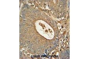 ACOX1 Monoclonal Antibody (ABIN659022 and ABIN2838046) immunohistochemistry analysis in formalin fixed and paraffin embedded human colon carcinoma followed by peroxidase conjμgation of the secondary antibody and DAB staining. (ACOX1 anticorps)