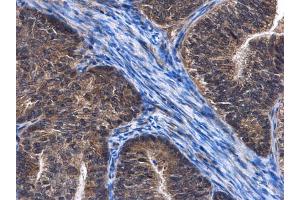 IHC-P Image C6orf97 antibody detects C6orf97 protein at cytoplasm in human endometrial cancer by immunohistochemical analysis. (CCDC170 anticorps  (C-Term))