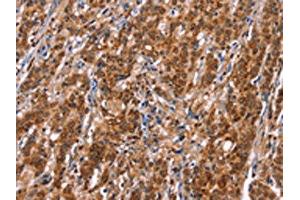 The image on the left is immunohistochemistry of paraffin-embedded Human gastic cancer tissue using ABIN7192753(TDP2 Antibody) at dilution 1/40, on the right is treated with synthetic peptide. (TDP2 anticorps)