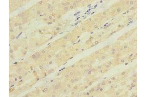 Immunohistochemistry of paraffin-embedded human gastric cancer using ABIN7143005 at dilution of 1:100