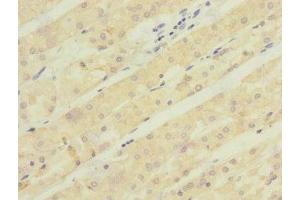 Immunohistochemistry of paraffin-embedded human gastric cancer using ABIN7143005 at dilution of 1:100 (ACCN5 anticorps  (AA 140-330))