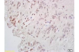 Formalin-fixed and paraffin embedded human cervial carcinoma labeled with Anti-CREB-1 Polyclonal Antibody, Unconjugated (ABIN723965) at 1:200 followed by conjugation to the secondary antibody and DAB staining.
