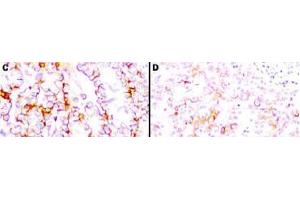 Immunohistochemistry (IHC) image for anti-Mesothelin (MSLN) (Extracellular Domain) antibody (ABIN400815) (Mesothelin anticorps  (Extracellular Domain))