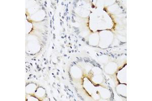 Immunohistochemistry of paraffin-embedded human colon using CCL22 antibody (ABIN5974972) at dilution of 1/100 (40x lens). (CCL22 anticorps)