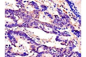 Immunohistochemistry of paraffin-embedded human colon cancer using ABIN7168925 at dilution of 1:100 (SPINK1 anticorps  (AA 19-79))