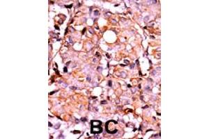 Formalin-fixed and paraffin-embedded human cancer tissue reacted with RAD9A (phospho S387) polyclonal antibody  which was peroxidase-conjugated to the secondary antibody followed by AEC staining. (RAD9A anticorps  (pSer387))