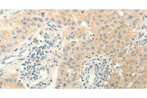 Immunohistochemistry of paraffin-embedded Human lung cancer using ERG Polyclonal Antibody at dilution of 1:40 (ERG anticorps)