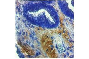 MMP1 in connective tissue in ovarian carcinoma was detected using HRP/DAB brown color stain.