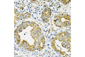 Immunohistochemistry of paraffin-embedded human gastric cancer using HSPA9 antibody. (HSPA9 anticorps  (AA 380-679))