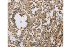 Immunohistochemistry of Human esophagus cancer using DSG2 Polyclonal Antibody at dilution of 1:70 (Desmoglein 2 anticorps)