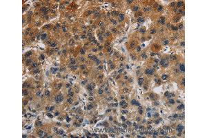 Immunohistochemistry of Human gastric cancer using CLDN8 Polyclonal Antibody at dilution of 1:50