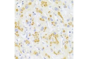 Immunohistochemistry of paraffin-embedded human liver cancer using FAS Antibody (ABIN5970062) at dilution of 1/100 (40x lens). (FAS anticorps)