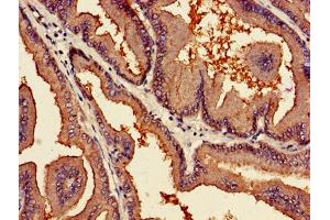 Immunohistochemistry of paraffin-embedded human prostate cancer using ABIN7163761 at dilution of 1:100 (PARN anticorps  (AA 1-639))