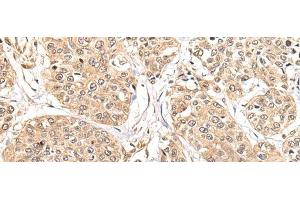 Immunohistochemistry of paraffin-embedded Human prost at e cancer tissue using ATL3 Polyclonal Antibody at dilution of 1:85(x200) (ATL3 anticorps)
