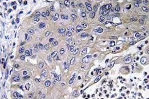 Immunohistochemistry (IHC) analyzes of Cathepsin D antibody in paraffin-embedded human lung carcinoma tissue. (Cathepsin D anticorps)
