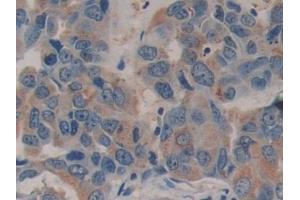 Detection of FAM3C in Human Breast cancer Tissue using Polyclonal Antibody to Family With Sequence Similarity 3, Member C (FAM3C) (FAM3C anticorps  (AA 25-227))