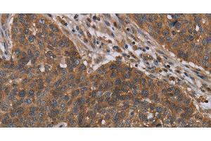 Immunohistochemistry of paraffin-embedded Human lung cancer tissue using OXTR Polyclonal Antibody at dilution 1:40
