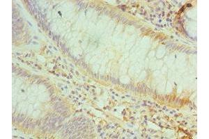 Immunohistochemistry of paraffin-embedded human colon cancer using ABIN7147161 at dilution of 1:100