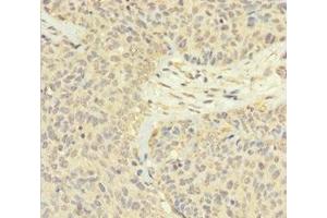 Immunohistochemistry of paraffin-embedded human ovarian cancer using ABIN7165526 at dilution of 1:100 (Protein FAM60A (SINHCAF) (AA 1-221) anticorps)