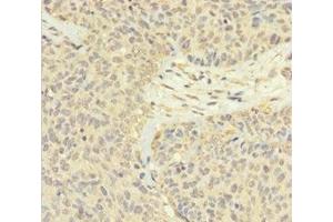 Immunohistochemistry of paraffin-embedded human ovarian cancer using ABIN7165526 at dilution of 1:100 (FAM60A anticorps  (AA 1-221))
