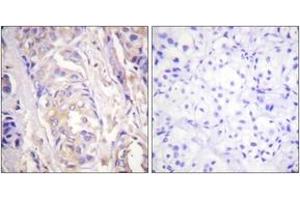 Immunohistochemistry analysis of paraffin-embedded human breast carcinoma tissue, using MEK1 (Ab-286) Antibody. (MEK1 anticorps  (AA 252-301))