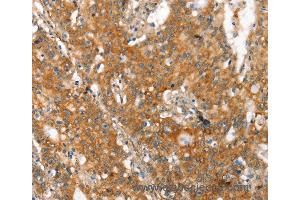 Immunohistochemistry of Human gastic cancer using MMP2 Polyclonal Antibody at dilution of 1:60 (MMP2 anticorps)