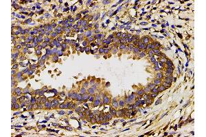 ABIN6267452 at 1/200 staining human myosarcoma tissue sections by IHC-P.