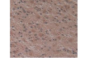 Detection of ATN1 in Human Glioma Tissue using Monoclonal Antibody to Atrophin 1 (ATN1)