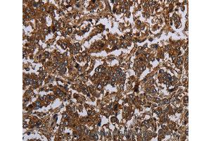 Immunohistochemistry of Human gastric cancer using HOMER2 Polyclonal Antibody at dilution of 1:30 (HOMER2 anticorps)