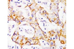 IHC-P: beta Catenin antibody testing of human breast cancer tissue