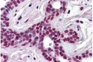 Human Breast (formalin-fixed, paraffin-embedded) stained with CUL3 antibody ABIN218508 at 1:500 followed by biotinylated goat anti-rabbit IgG secondary antibody ABIN481713, alkaline phosphatase-streptavidin and chromogen. (Cullin 3 anticorps  (N-Term))