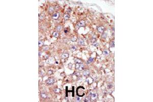 Formalin-fixed and paraffin-embedded human hepatocellular carcinoma tissue reacted with PTK6 polyclonal antibody  , which was peroxidase-conjugated to the secondary antibody, followed by AEC staining. (PTK6 anticorps  (N-Term))