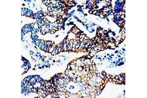 Immunohistochemical analysis of paraffin embedded rectal carcinoma sections, staining CCR5 in cytoplasm, DAB chromogenic reaction