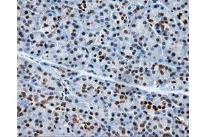 Immunohistochemical staining of paraffin-embedded Adenocarcinoma of colon tissue using anti-RC204952 mouse monoclonal antibody. (XRCC1 anticorps)