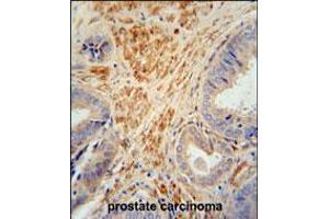 FSTL1 antibody immunohistochemistry analysis in formalin fixed and paraffin embedded human prostate carcinoma followed by peroxidase conjugation of the secondary antibody and DAB staining.