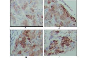 Immunohistochemical analysis of paraffin-embedded human hepatocarcinoma (A), breast carcinoma (B) and lung cancer tissues (C), showing cytoplasmic localization with DAB staining using PEG10 mouse mAb.