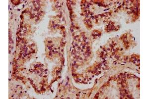 IHC image of ABIN7149635 diluted at 1:400 and staining in paraffin-embedded human prostate cancer performed on a Leica BondTM system. (CXORF36 anticorps  (AA 311-405))