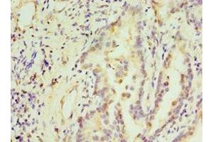 Immunohistochemistry of paraffin-embedded human lung cancer using ABIN7171228 at dilution of 1:100 (Syntaxin 16 anticorps  (AA 1-300))